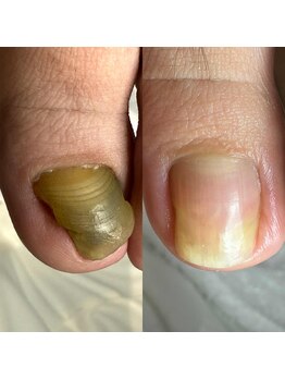 ランカ(RUNKA)の写真/爪の悩み専門サロン１万５千症例以上の症例を誇る日本トップクラスの技術力で世界からお客様がご来店