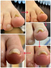 ネイルサロン ピーアンドビー(P&B)/巻爪補修