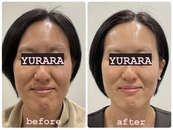 ユララ(YURARA)/一度で驚きの効果♪♪