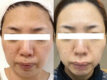 サフィール(Saphir)の雰囲気（どんな肌悩みもこれでOK！希少な臍帯由来の美肌幹細胞導入Lit）