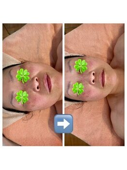 ルソワン(Le.soin)/【小顔】 ビフォーアフター