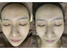 エッセンシャル 南海難波店(ESSENTIAL)/【REVI】ハーブピーリング