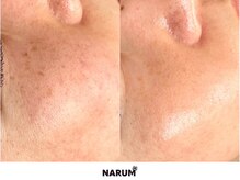 ナルムフェイシャル 代々木(NARUM facial)/