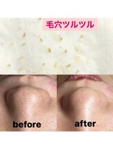 ビューティーネイル(Beauty Nail)/毛穴エクストラクション