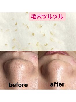 ビューティーネイル(Beauty Nail)/毛穴エクストラクション