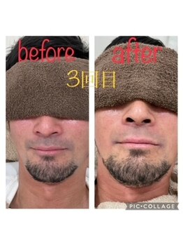 サーディン(sardine)/メンズ人気NO、1ヒゲ脱毛