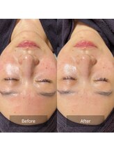 モンレーヴ/安全な施術を心がけています♪