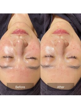 モンレーヴ/安全な施術を心がけています♪