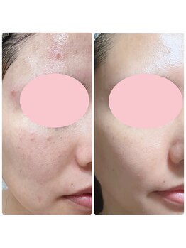 シェリアン(Cherien)/ニキビ、肌荒れケア