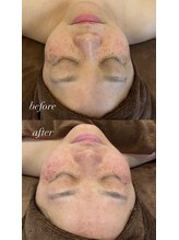 エレニア 住吉店(Elenear)/純度100%ヒト幹細胞培養液導入！