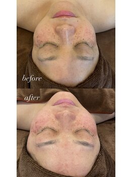 エレニア 住吉店(Elenear)/純度100%ヒト幹細胞培養液導入！