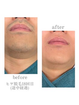 アデージョ アデオス(Ade-jyo.Adeosu)/【ひげ脱毛】