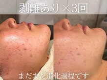 ジプソフィラフィフティドット(gypsophira15.)の雰囲気(すべて1回の変化です。黒ずみ毛穴諦めてませんか?)