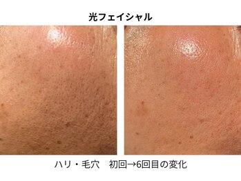 エルヴェ(Eleve)/ハリ感、じんわりアップ