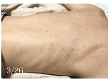 ピリナ 名古屋/【背中ハーブピーリング】症例