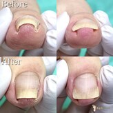 巻き爪補正店 小倉店