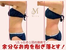 ミラ 札幌店(Mira)/1回目施術ビフォーアフター