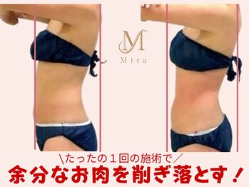 ミラ 札幌店(Mira)/1回目施術ビフォーアフター
