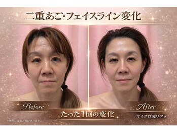 キャンディ 海老名駅前店(Candy)/マイクロ波リフト/海老名/