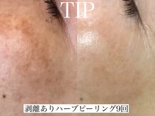 アリス(ALICE)/シミ、くすみにハーブピーリング