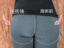 ヨサパーク アカーシャ(YOSA PARK AKASHA)/1回の施術での変化。