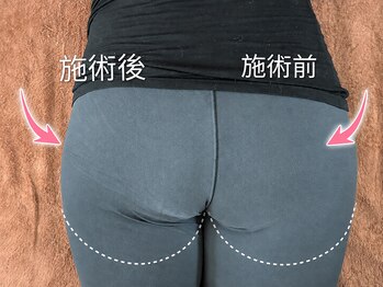 ヨサパーク アカーシャ(YOSA PARK AKASHA)/1回の施術での変化。