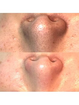 ジプソフィラフィフティドット(gypsophira15.)/施術