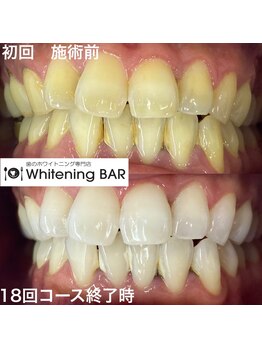 ホワイトニングバー 福島店/18回コース終了ビフォーアフター
