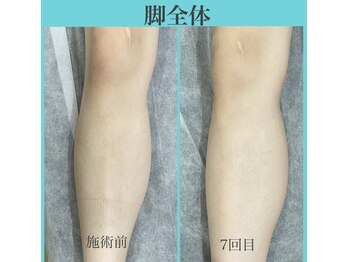 アクト クロ(ACT curro)/【脚全体】脱毛施術例