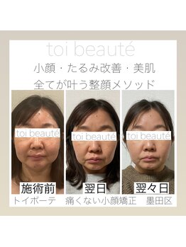 トイボーテ(toi beaute)/新しい自分に出会える整顔ヘッド