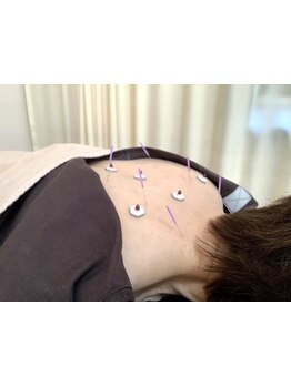 鍼灸施術を受けたい