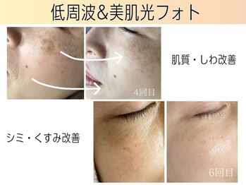 シャイニングビューティー 表参道(Shining Beauty)/本格シミ改善