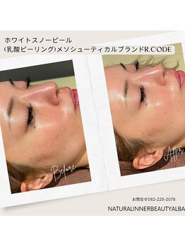 アルバ 広島店(ALBA)/【美白シミケア】白玉ピーリング