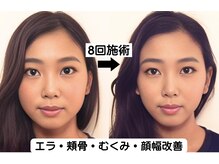 ニュートラル 渋谷店(NEUTRAL)/小顔矯正結果［小顔/骨盤］