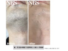 ライチェンド(Reizend)/ヒゲ脱毛のBefore after