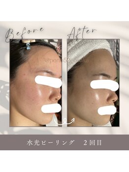 ポノ(PONO)/水光ピーリング