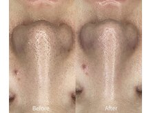 リプラス(Replus)の雰囲気(施術直後からトーンアップして毛穴も引き締まる♪)