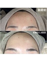 エミルカ 鹿児島店(EMILUCA)/ハーブピーリング　顔　