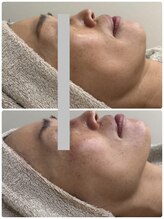 メディカルエース(MedicalAce)/ブライティングリフト