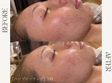 ルカ 北堀江(Luca)/1回でニキビの赤みがうすく。