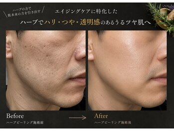 アルト(ALTO)の写真/年齢サインにアプローチ！色素沈着最高級ハーブ仕様でシミ改善＆たるみ・ハリ・つやケア◎