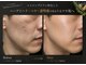 アルト(ALTO)の写真/年齢サインにアプローチ！色素沈着最高級ハーブ仕様でシミ改善＆たるみ・ハリ・つやケア◎