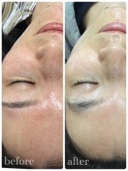 メイユール(MEILLEUR)/光フェイシャル3回