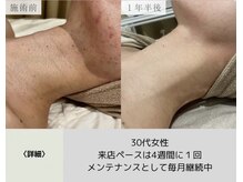 ボータン 恵(Beau Temps)/ハーブピーリング