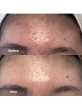 モカ 天王寺店(MOKA)/剥離2回ハーブ　おでこ　ニキビ