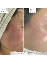 レイ(Rey)/オーダーメイド肌質改善コース