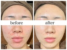 アリエス/肌質改善［毛穴/黒ずみ/ニキビ］