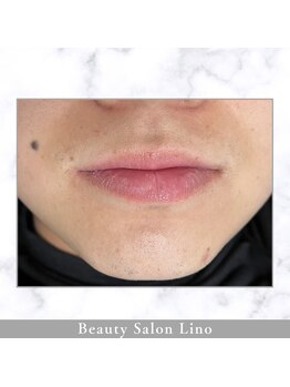 リノ(Lino)の写真/【清潔感も、自信も、ヒゲのない朝から始まる！】自分に合ったスタイルで通える♪部位も選べてコスパ◎