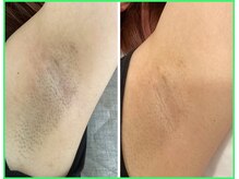 クリア 尾張旭店(Clear)/【Clear脱毛ビフォーアフター】