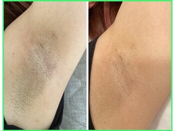 クリア 尾張旭店(Clear)/【Clear脱毛ビフォーアフター】